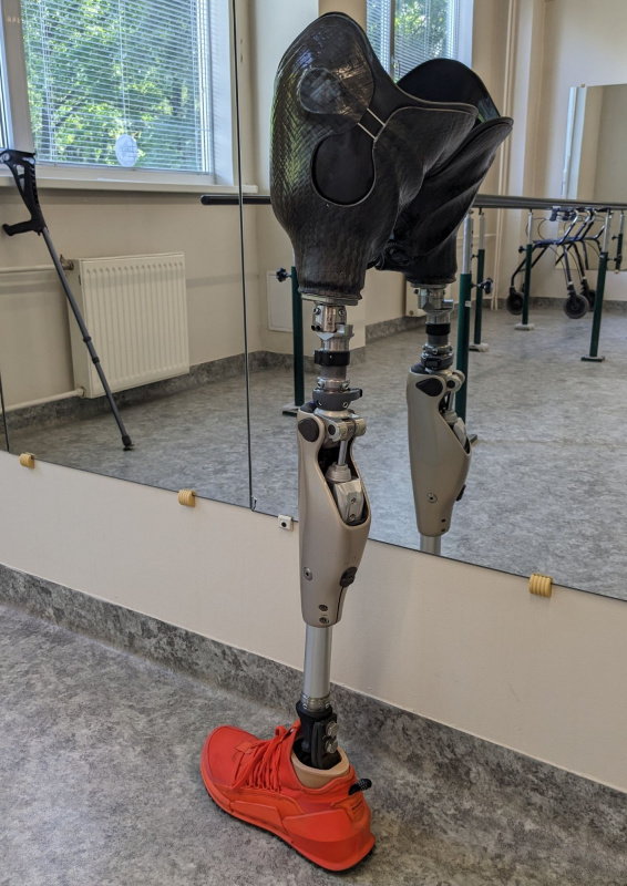 5 augšstilba protēze ar mīksto iekšējo čaulu, savelkamu ārējo čaulu un mikroprocesora ceļa locītavu, dinamiskā oglekļa šķiedras pēda